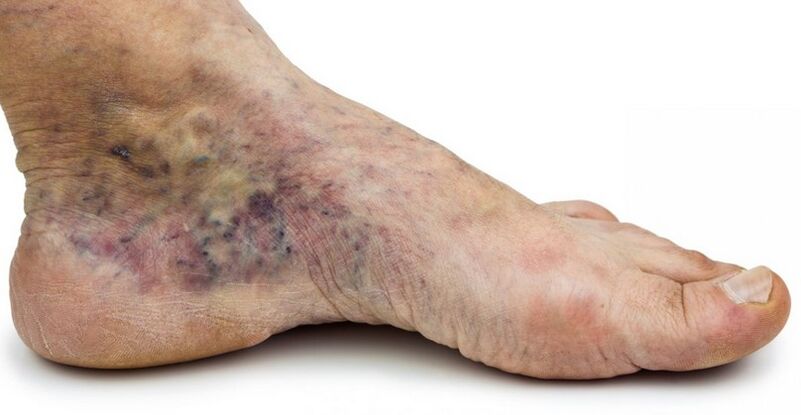 Stadij C4c – kruna stopala, flebitis u sredini